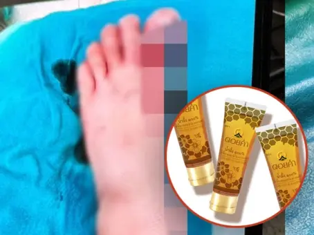 หมอเล่าเคส เด็ก 5 ขวบ โดนรถชนเป็นแผลใหญ่ เปิดภาพล่าสุดหลังใช้น้ำผึ้งดอยคำรักษา
